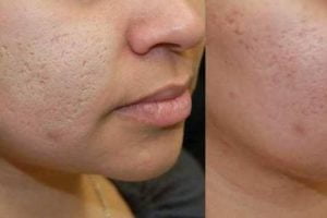 cara2520hilangkan2520parut2520jerawat1