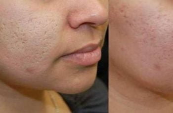 cara2520hilangkan2520parut2520jerawat1