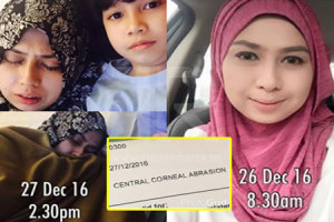 Mata Nyaris Buta Gara-gara Pakai Contact Lens