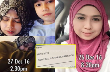 Mata Nyaris Buta Gara-gara Pakai Contact Lens