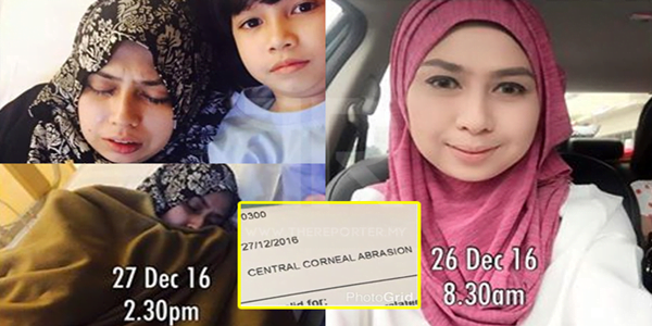 Kerana Mahu Cantik, Mata Nyaris Buta Gara-gara Pakai Contact Lens 1 Mata Nyaris Buta Gara-gara Pakai Contact Lens